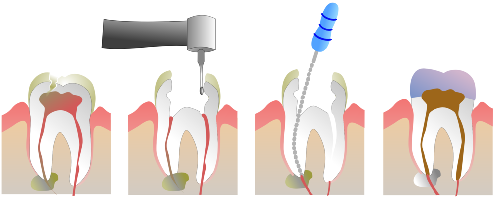 Root canal treatment in Kerala