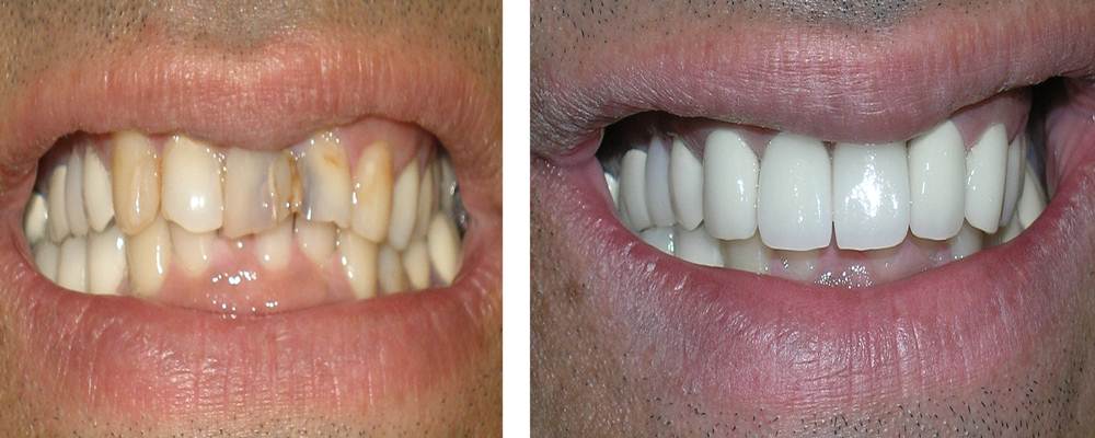Discolored And Stained Tooth